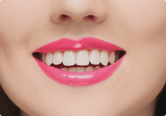 Whitening and cosmetic outcomes after