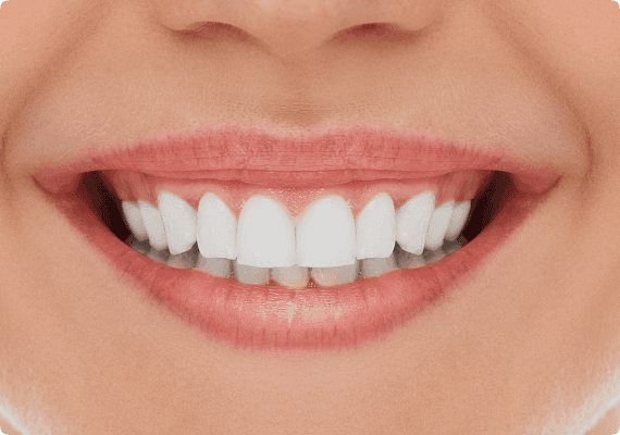 Alignment and smile refinement after