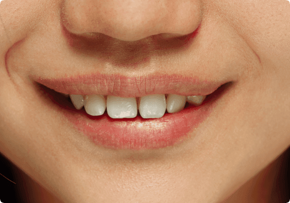 Whitening and cosmetic outcomes before