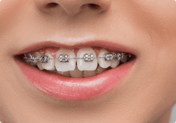 Alignment and smile refinement before